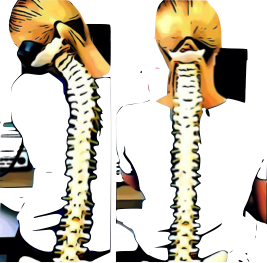 Photo d'une colonne vertébrale tordue et photo d'une colonne vertébrale droite